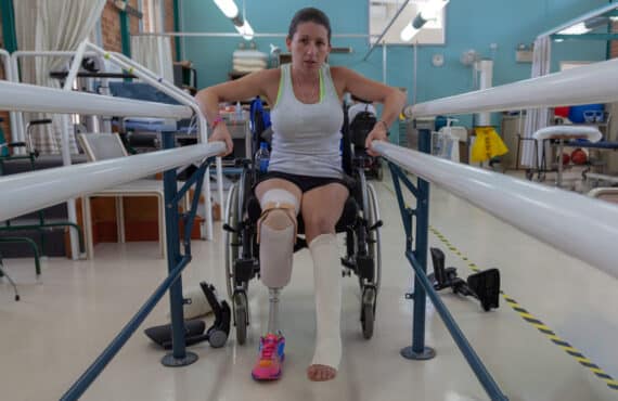 How Much Will Workers’ Comp Pay for an Amputation in South Carolina?