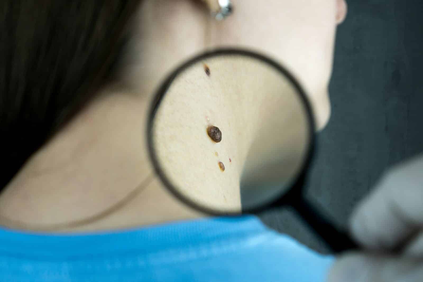 Misdiagnosis of Melanoma, <br>A Growing Concern