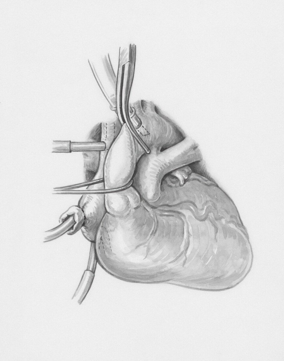 Aneurysm Repairs </br> New Medical Device at MUSC